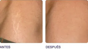 Antes y después del tratamiento de estrías